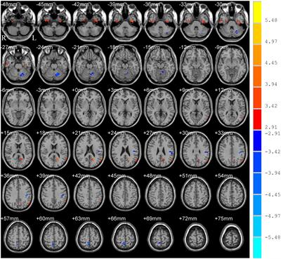 Aberrant Amplitude of Low-Frequency Fluctuations in Different Frequency Bands in Patients With Parkinson’s Disease